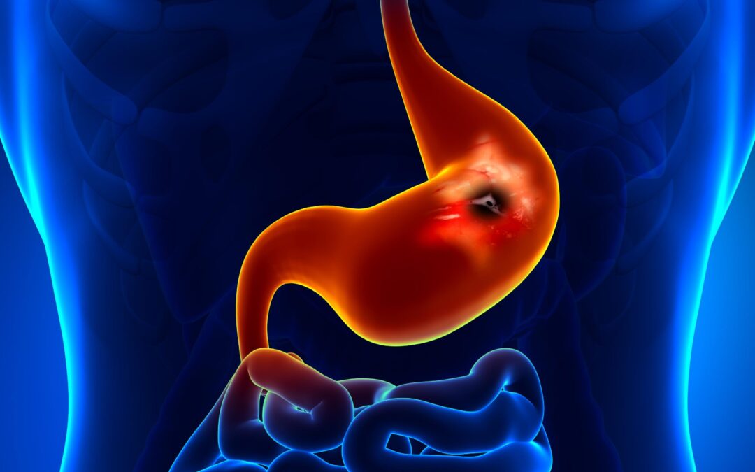 COMO SANAR ULCERAS PEPTICAS – COMO SANAR LA GASTRITIS REPOLLO MORADO