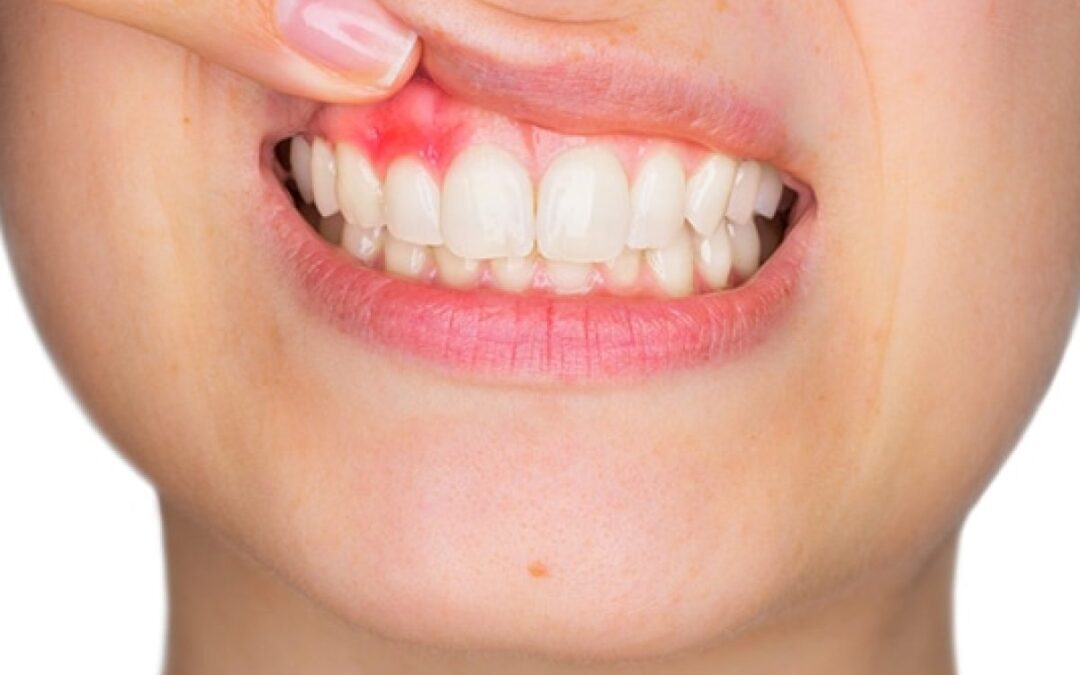 PERIODONTITIS