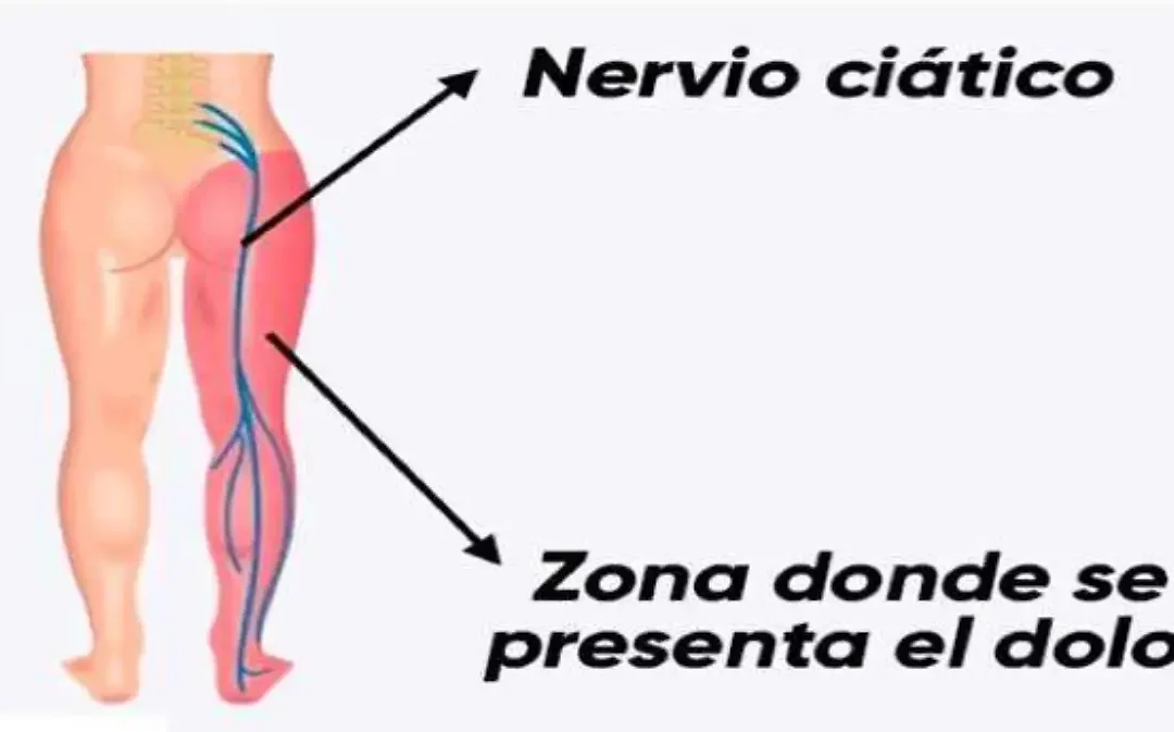 DOLOR EN EL NERVIO CIÁTICO – 23-ABRIL-2022 – LUIS A MELON