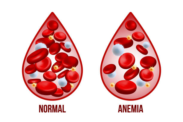 ANEMIA_ Alimentos Ricos en Hierro – Como subir la Hemoglobina – Luis Antonio Melón